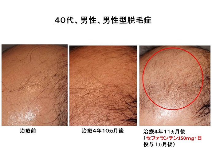 円形脱毛症　病院